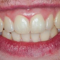 Teeth Whitening - Smile 3 before